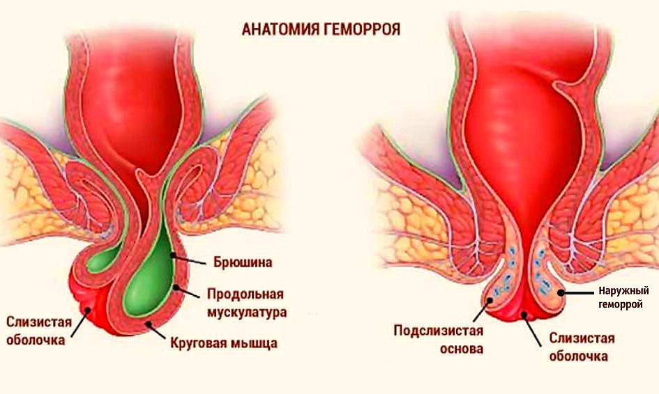 Лечение геморроя: причины, симптомы у мужчин и женщин