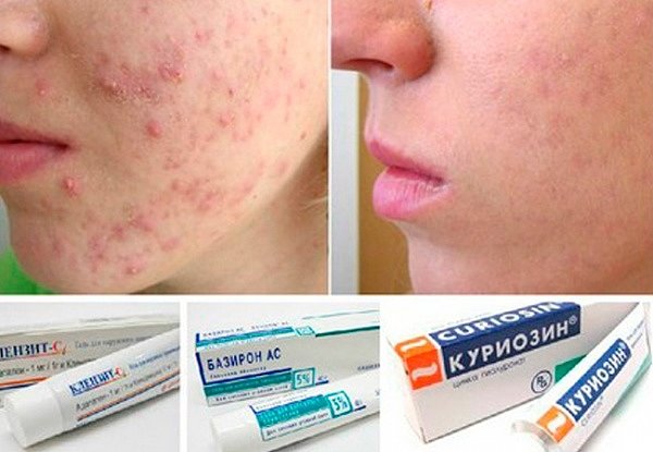 Лечение угревой сыпи на лице у женщин препараты схема лечения
