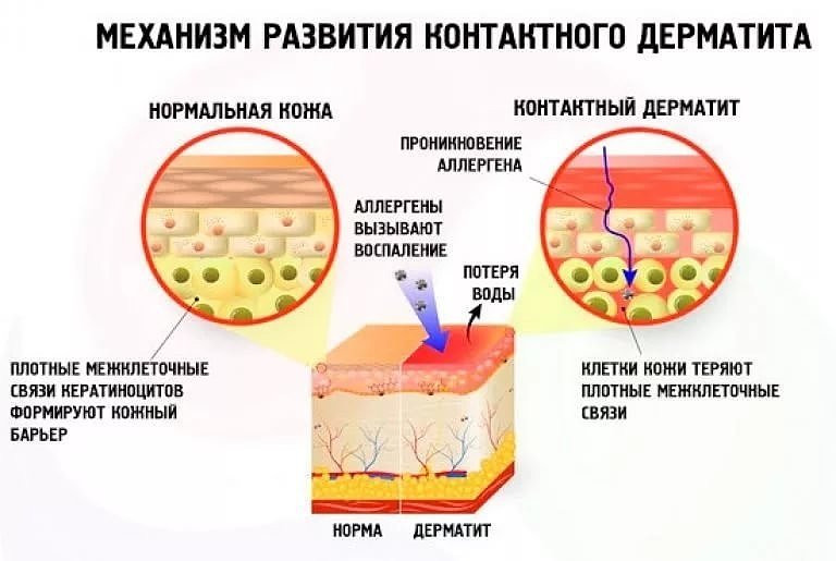 Как развивается контактный дерматит