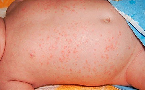 Аллергический дерматит у ребенка