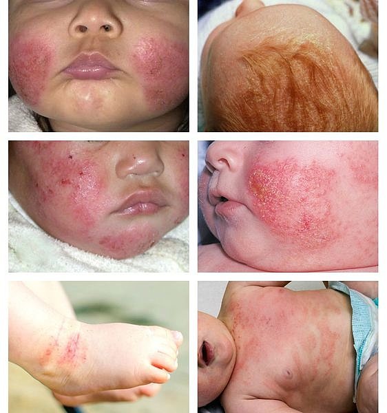 Первые признаки дерматита в младенческом возрасте, фото