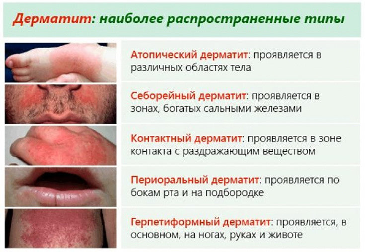 Распространенные виды дерматита