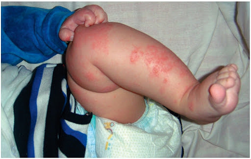 Везикулезно-крустозная форма атопического дерматита, фото