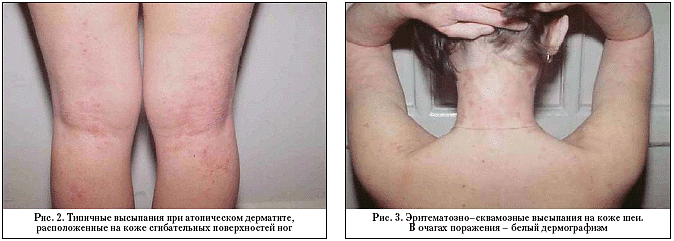 Эриматозно-сквамозная форма атопического дерматитас лихенификацией, фото